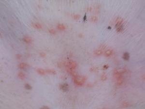 benjolan berisi nanah pada perut, 